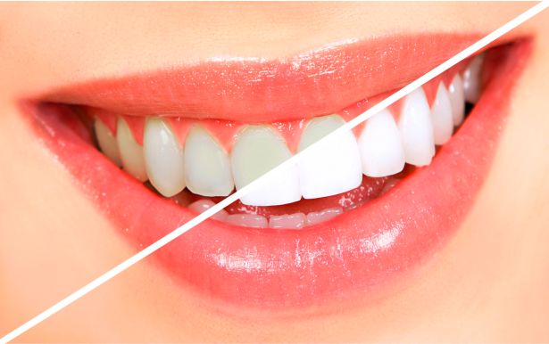 wybielanie zębów przez dentystę, efekt przed i po wybielaniu zębów